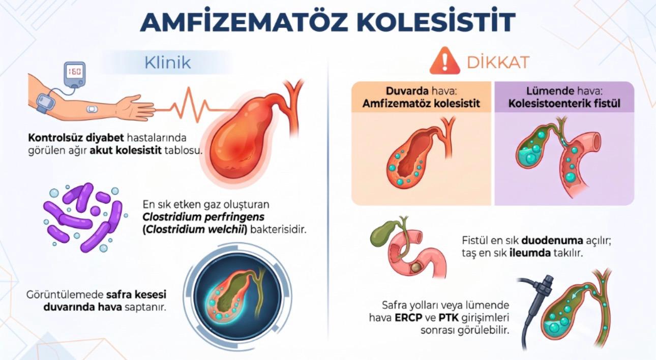 Amfizematöz kolesistit orijinal Frame örneği